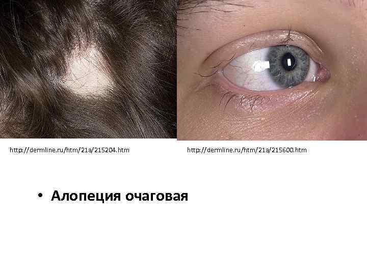 http: //dermline. ru/htm/21 a/215204. htm http: //dermline. ru/htm/21 a/215600. htm • Алопеция очаговая 