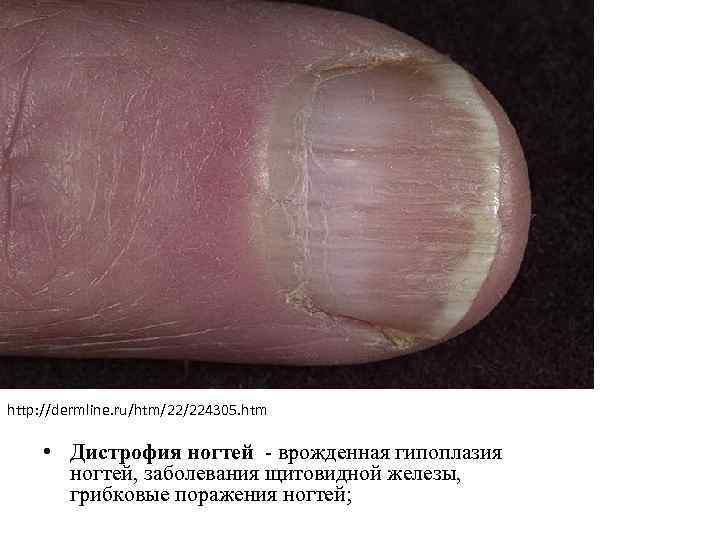 http: //dermline. ru/htm/22/224305. htm • Дистрофия ногтей - врожденная гипоплазия ногтей, заболевания щитовидной железы,