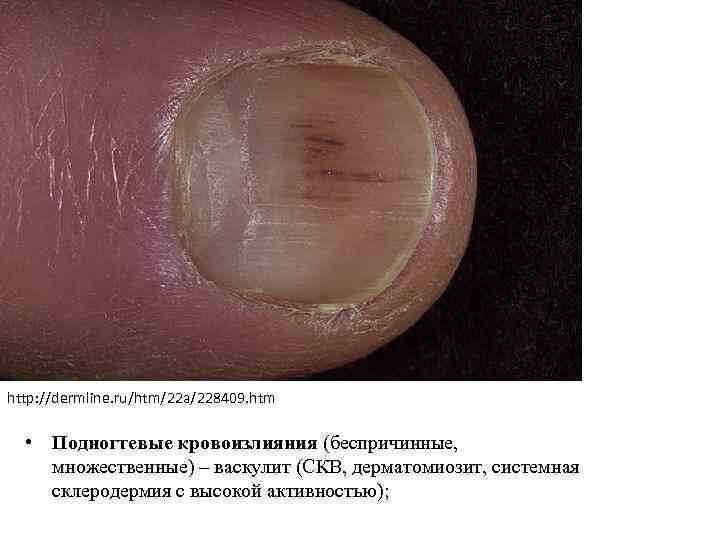 http: //dermline. ru/htm/22 a/228409. htm • Подногтевые кровоизлияния (беспричинные, множественные) – васкулит (СКВ, дерматомиозит,