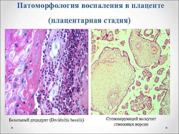 Патоморфология воспаления в плаценте (плацентарная стадия) Базальный децидуит (Deciduitis basalis) Стенозирующий васкулит стволовых ворсин