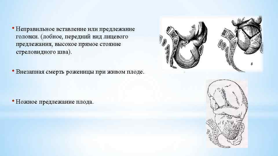  • Неправильное вставление или предлежание головки. (лобное, передний вид лицевого предлежания, высокое прямое