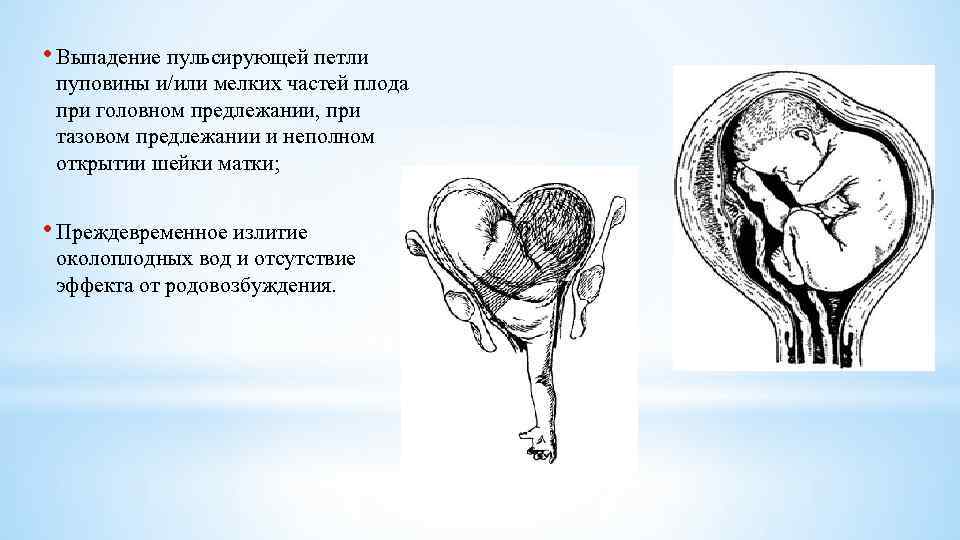  • Выпадение пульсирующей петли пуповины и/или мелких частей плода при головном предлежании, при