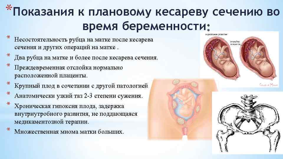 *Показания к плановому кесареву сечению во время беременности * Несостоятельность рубца на мaтке после