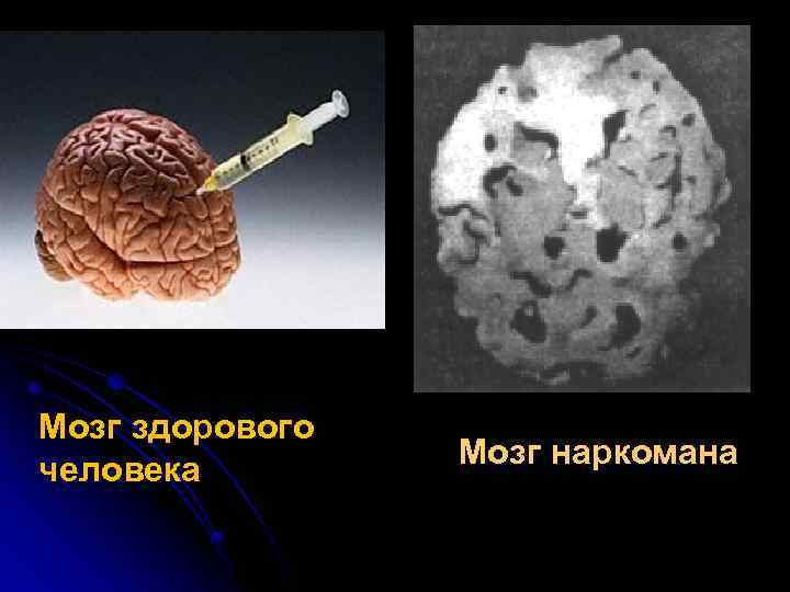 Мозг здорового человека Мозг наркомана 