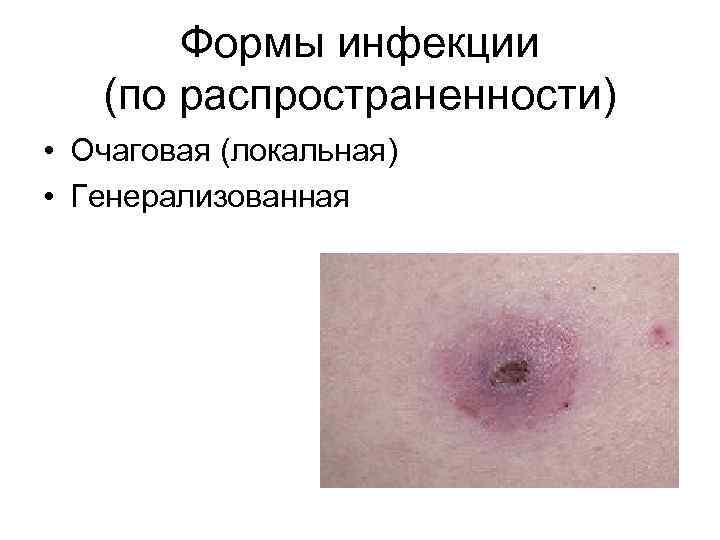 Формы инфекции (по распространенности) • Очаговая (локальная) • Генерализованная 
