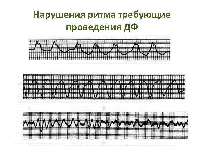 Нарушения ритма требующие проведения ДФ 