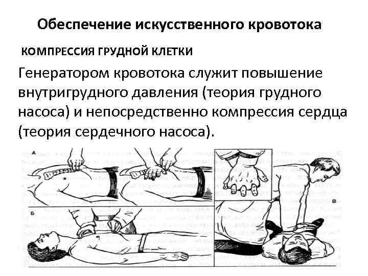 Обеспечение искусственного кровотока КОМПРЕССИЯ ГРУДНОЙ КЛЕТКИ Генератором кровотока служит повышение внутригрудного давления (теория грудного