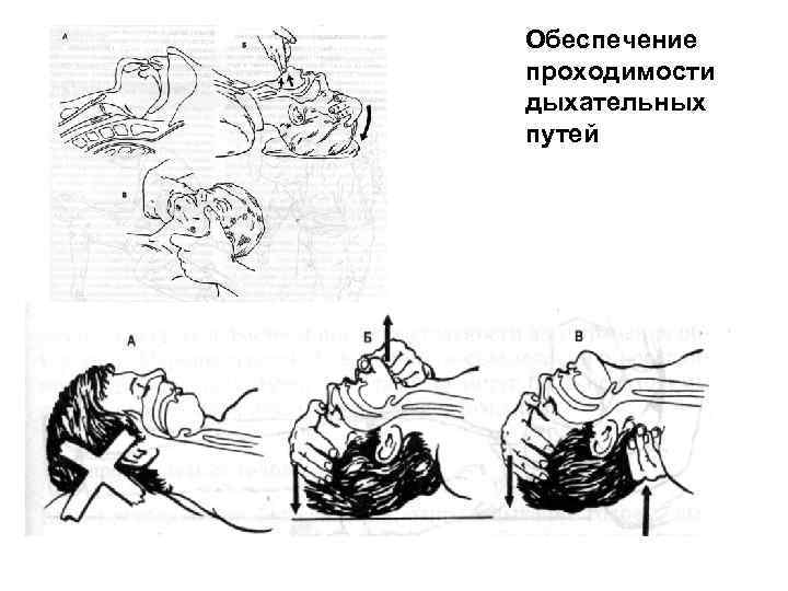 Обеспечение проходимости дыхательных путей 