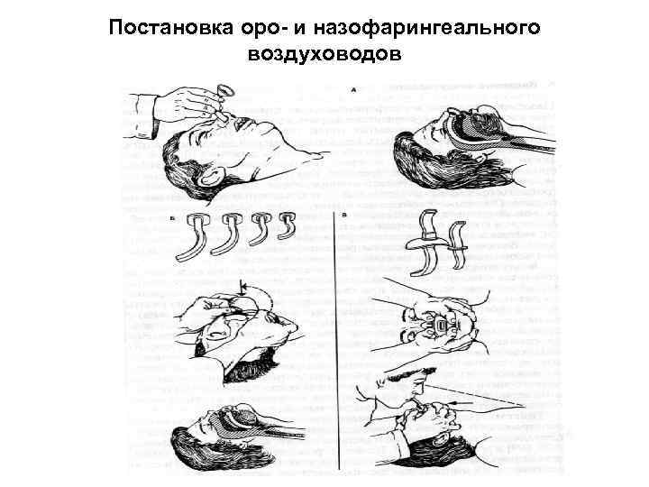 Постановка оро- и назофарингеального воздуховодов 