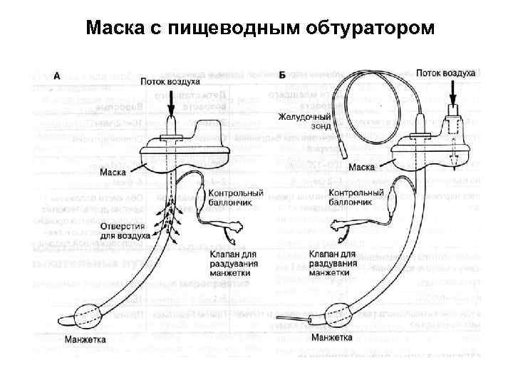 Маска с пищеводным обтуратором 