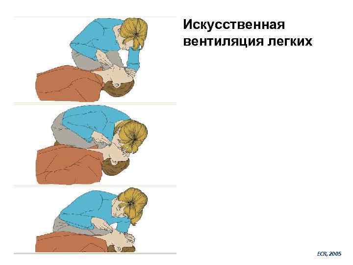 Искусственная вентиляция легких ECR, 2005 