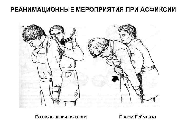 РЕАНИМАЦИОННЫЕ МЕРОПРИЯТИЯ ПРИ АСФИКСИИ Похлопывания по снине Прием Геймлиха 