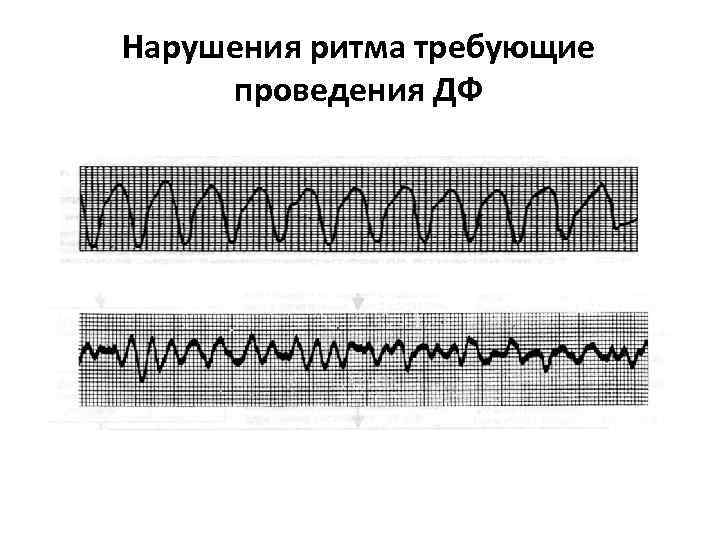 Нарушения ритма требующие проведения ДФ 