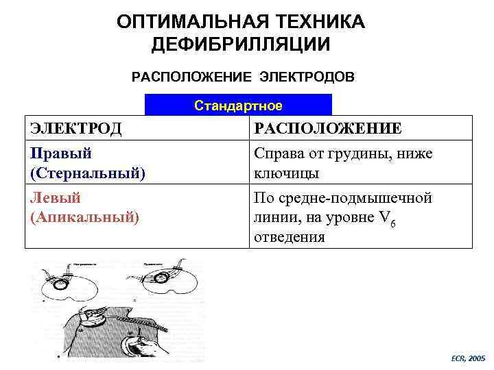 ОПТИМАЛЬНАЯ ТЕХНИКА ДЕФИБРИЛЛЯЦИИ РАСПОЛОЖЕНИЕ ЭЛЕКТРОДОВ Стандартное ЭЛЕКТРОД Правый (Стернальный) РАСПОЛОЖЕНИЕ Справа от грудины, ниже