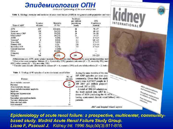 Эпидемиология ОПН Epidemiology of acute renal failure: a prospective, multicenter, communitybased study. Madrid Acute