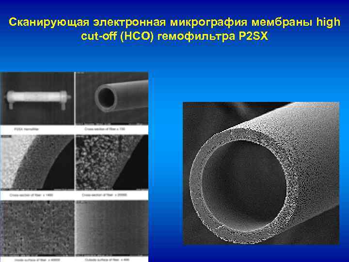 Сканирующая электронная микрография мембраны high cut-off (HCO) гемофильтра P 2 SX 