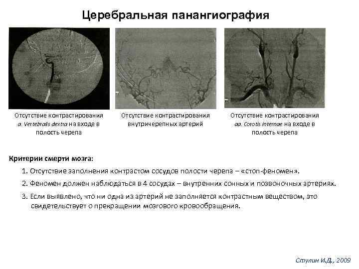 Церебральная панангиография Отсутствие контрастирования а. Vertebralis dextra на входе в полость черепа Отсутствие контрастирования