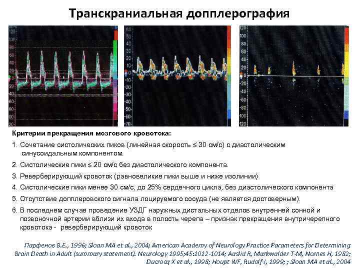 Транскраниальная допплерография Критерии прекращения мозгового кровотока: 1. Сочетание систолических пиков (линейная скорость 30 см/с)