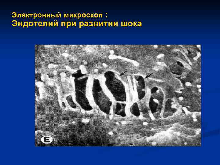 Электронный микроскоп : Эндотелий при развитии шока 