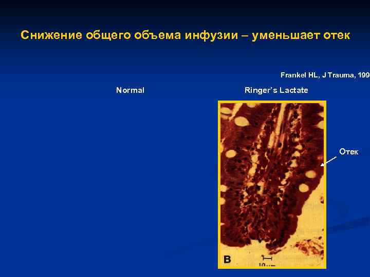 Снижение общего объема инфузии – уменьшает отек Frankel HL, J Trauma, 1996 Normal Ringer’s