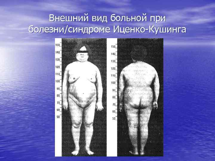 Внешний вид больной при болезни/синдроме Иценко-Кушинга 
