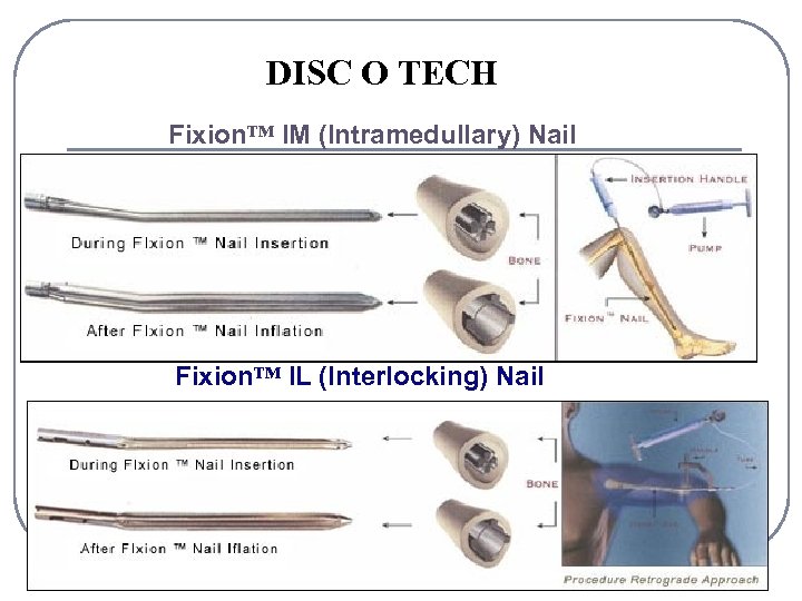 DISC O TECH Fixion™ IM (Intramedullary) Nail Fixion™ IL (Interlocking) Nail 1 