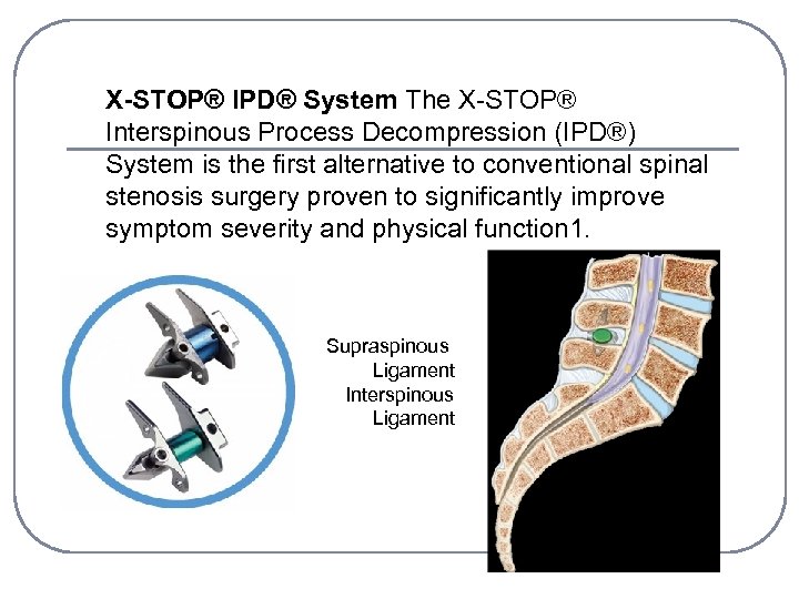 X-STOP® IPD® System The X-STOP® Interspinous Process Decompression (IPD®) System is the first alternative