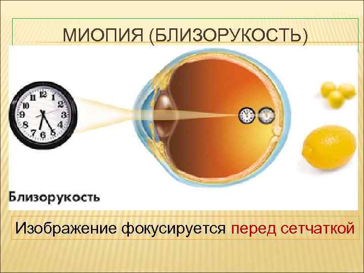 Где фокусируется изображение предмета при близорукости