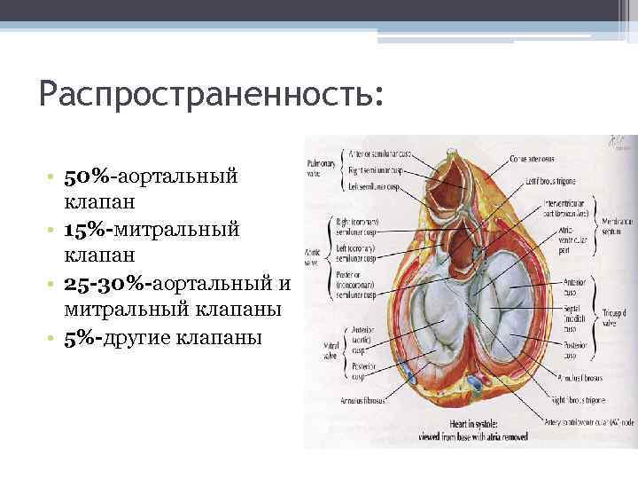 Распространенность: • 50%-аортальный клапан • 15%-митральный клапан • 25 -30%-аортальный и митральный клапаны •