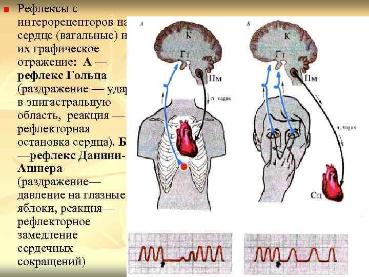 n Рефлексы с интерорецепторов на сердце (вагальные) и их графическое отражение: А — рефлекс