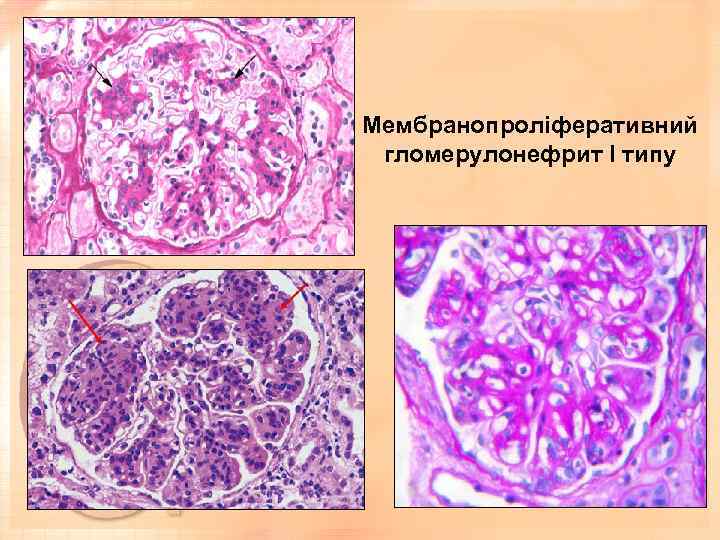 Мембранопроліферативний гломерулонефрит І типу 