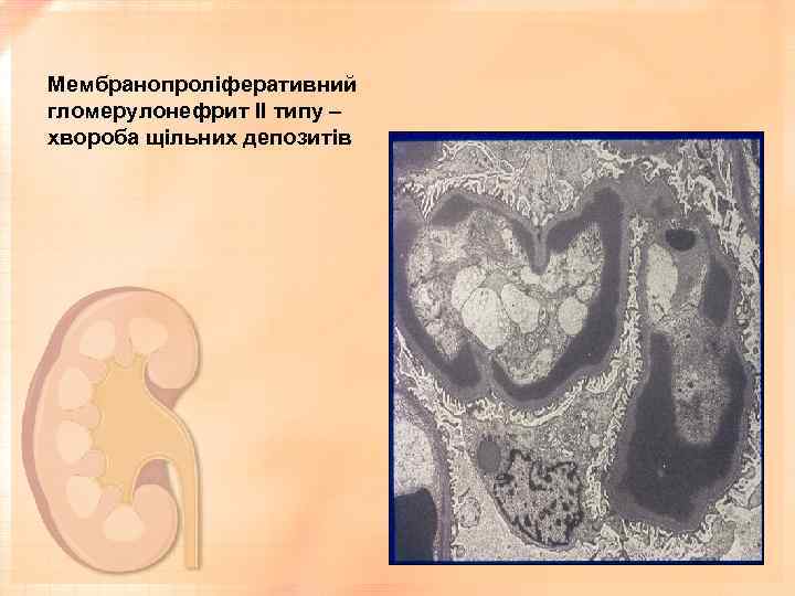 Мембранопроліферативний гломерулонефрит ІІ типу – хвороба щільних депозитів 