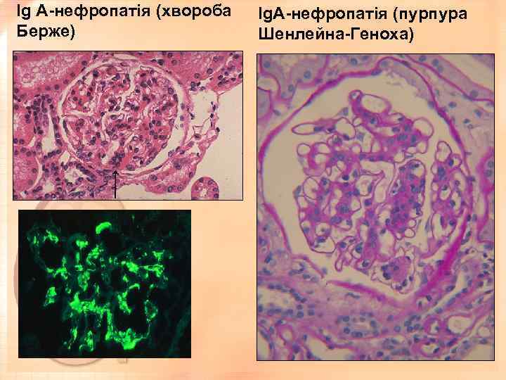 Ig A-нефропатія (хвороба Берже) Ig. A-нефропатія (пурпура Шенлейна-Геноха) 