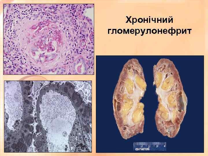 Хронічний гломерулонефрит 