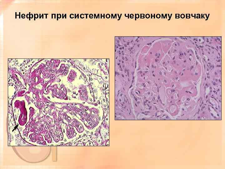 Нефрит при системному червоному вовчаку 