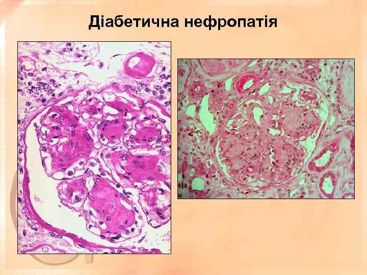 Діабетична нефропатія 