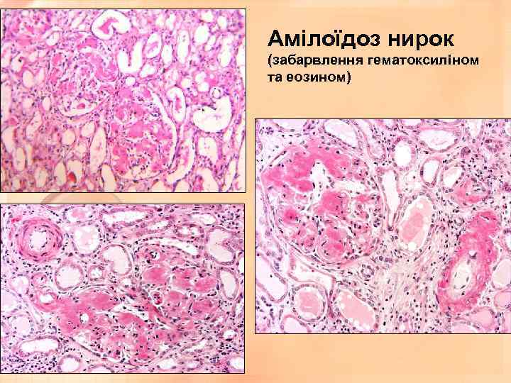 Амілоїдоз нирок (забарвлення гематоксиліном та еозином) 