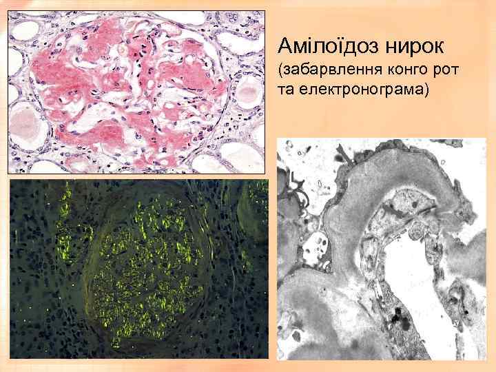 Амілоїдоз нирок (забарвлення конго рот та електронограма) 