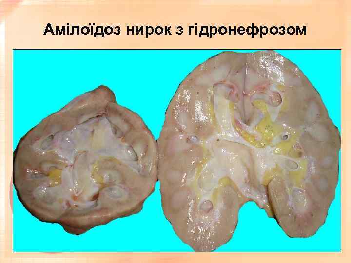 Амілоїдоз нирок з гідронефрозом 