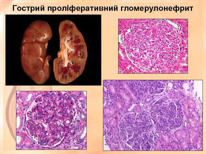 Гострий проліферативний гломерулонефрит 