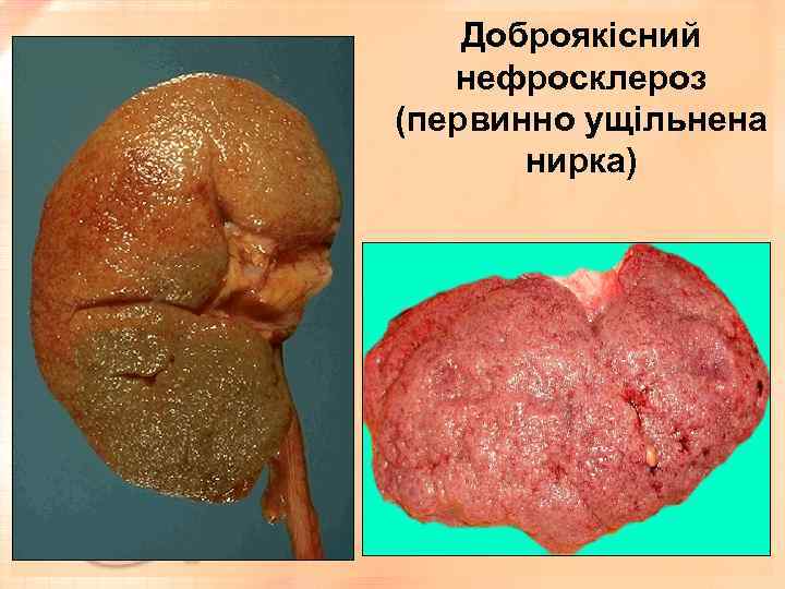 Доброякісний нефросклероз (первинно ущільнена нирка) 