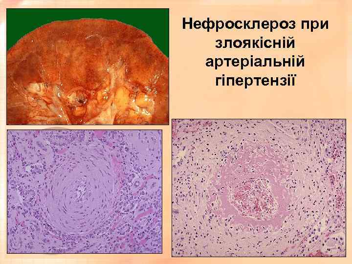 Нефросклероз при злоякісній артеріальній гіпертензії 