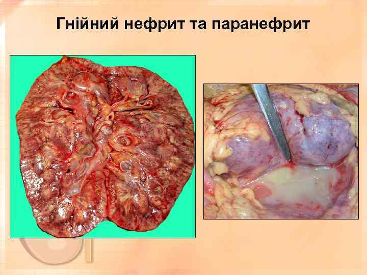 Гнійний нефрит та паранефрит 