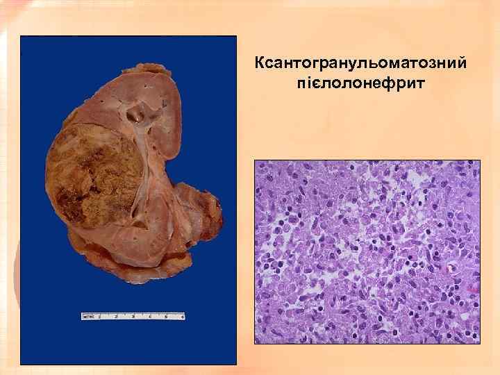 Ксантогранульоматозний пієлолонефрит 