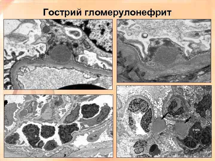 Гострий гломерулонефрит 