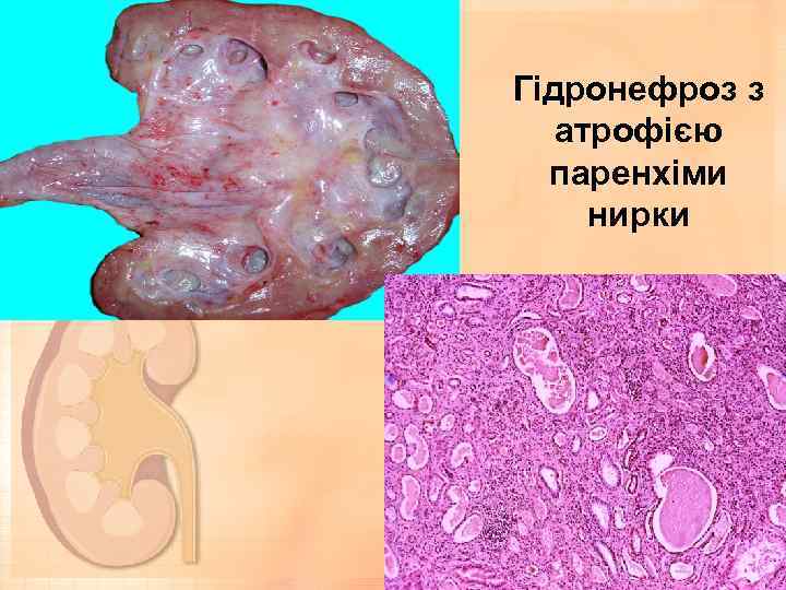 Гідронефроз з атрофією паренхіми нирки 