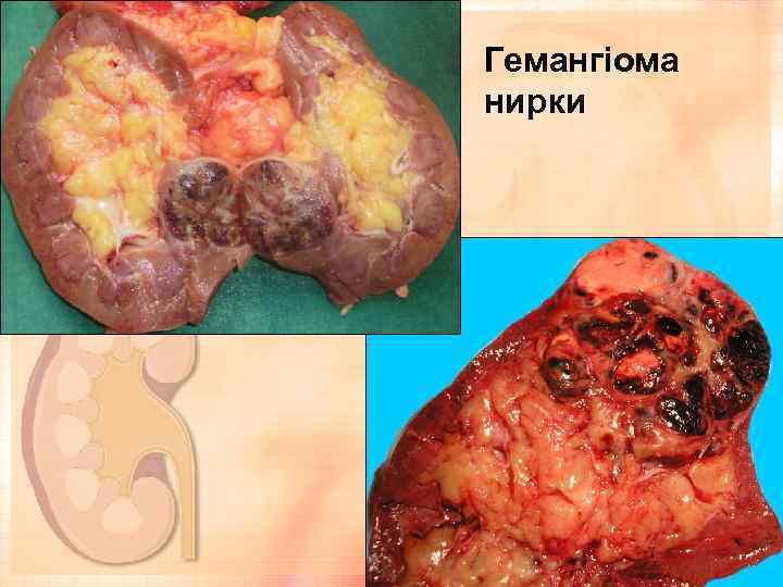 Гемангіома нирки 