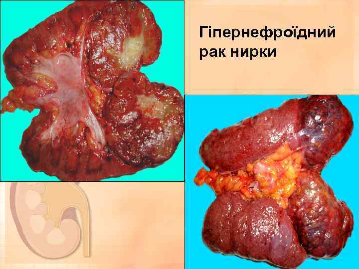 Гіпернефроїдний рак нирки 