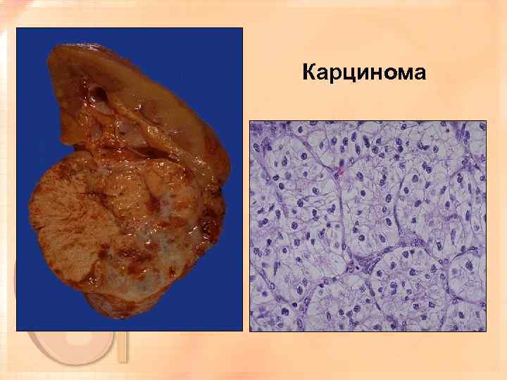 Карцинома 