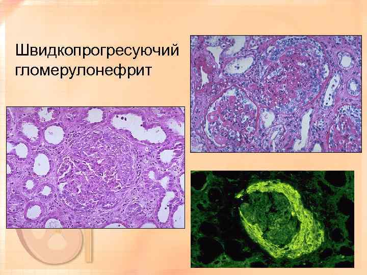 Швидкопрогресуючий гломерулонефрит 